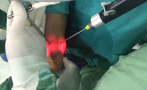 Ankle_Arthroscopy