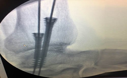 Arthroscopic Assisted Fusions