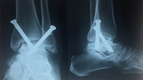 Avascular-Necrosis-e1753533092418.jpg