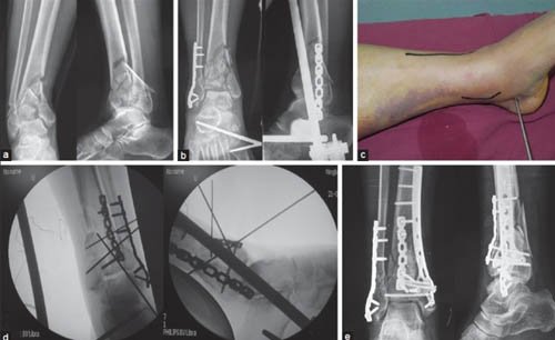 Complex Fractures Treatment