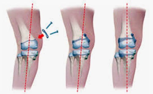 Deformity Correction