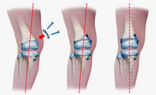 Deformity Correction Treatment