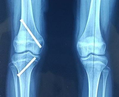 Deformity Correction