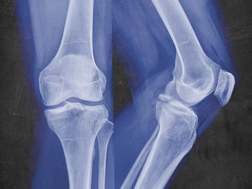 Fracture Surgeries Treatment