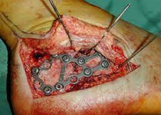 Fracture Surgery