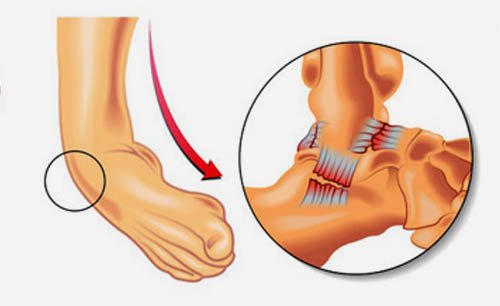 Instability Ankle Joint Surgery