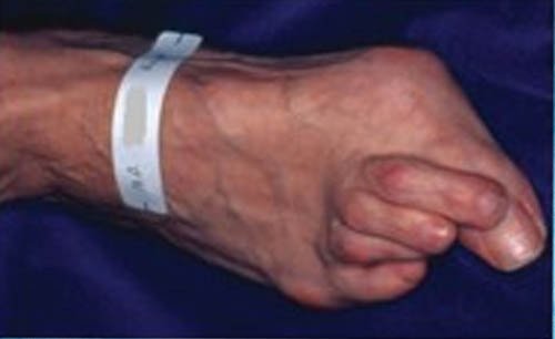 Rheumatoid Forefoot