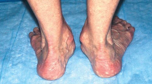 Rheumatoid Hindfoot