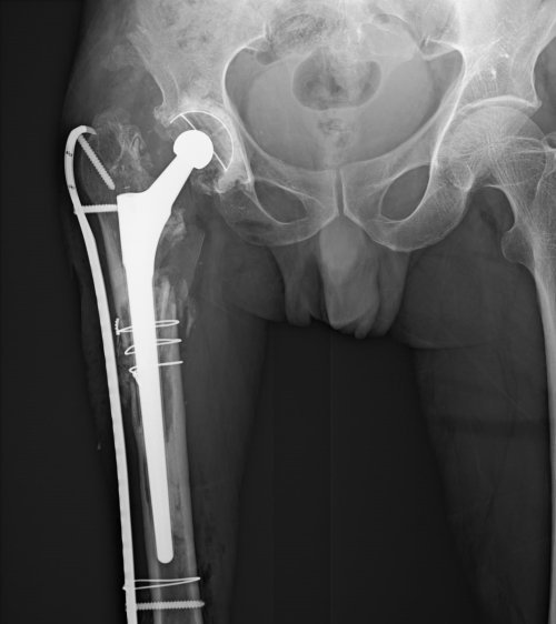 Total Hip Replacement