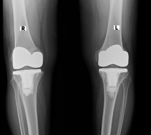 Total Knee Replacement