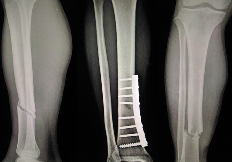 Complex   Fractures