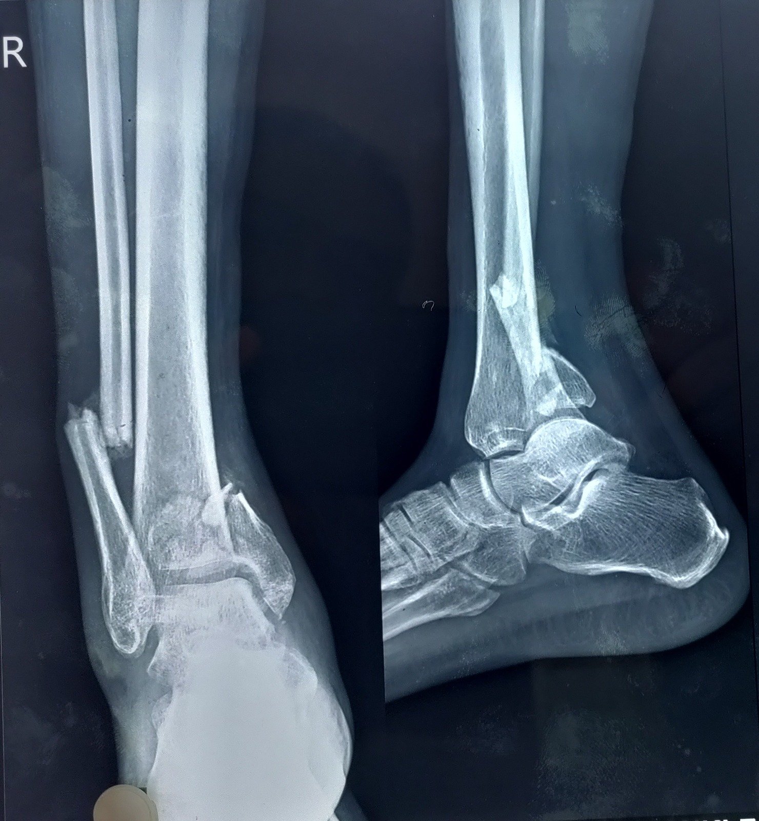 Foot fracture shown on orthopedic X-ray imaging