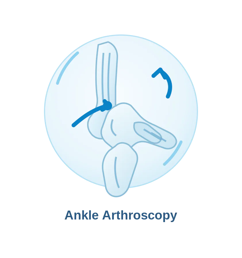 Ankle arthroscopy for ankle joint conditions