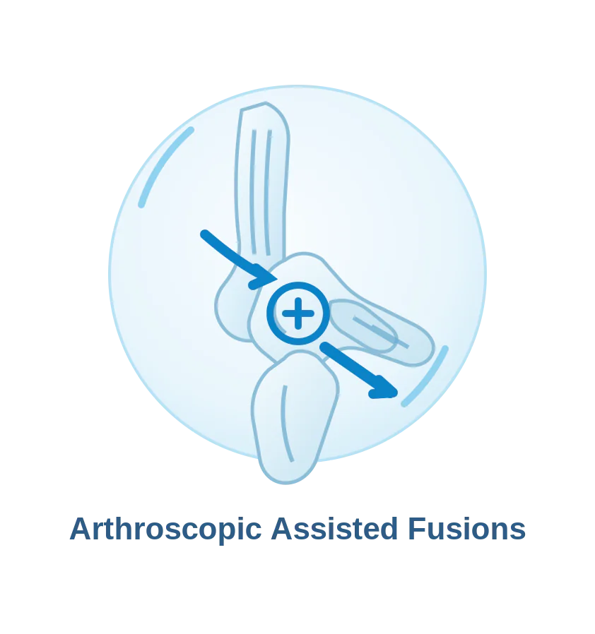 Arthroscopic assisted ankle fusion procedure