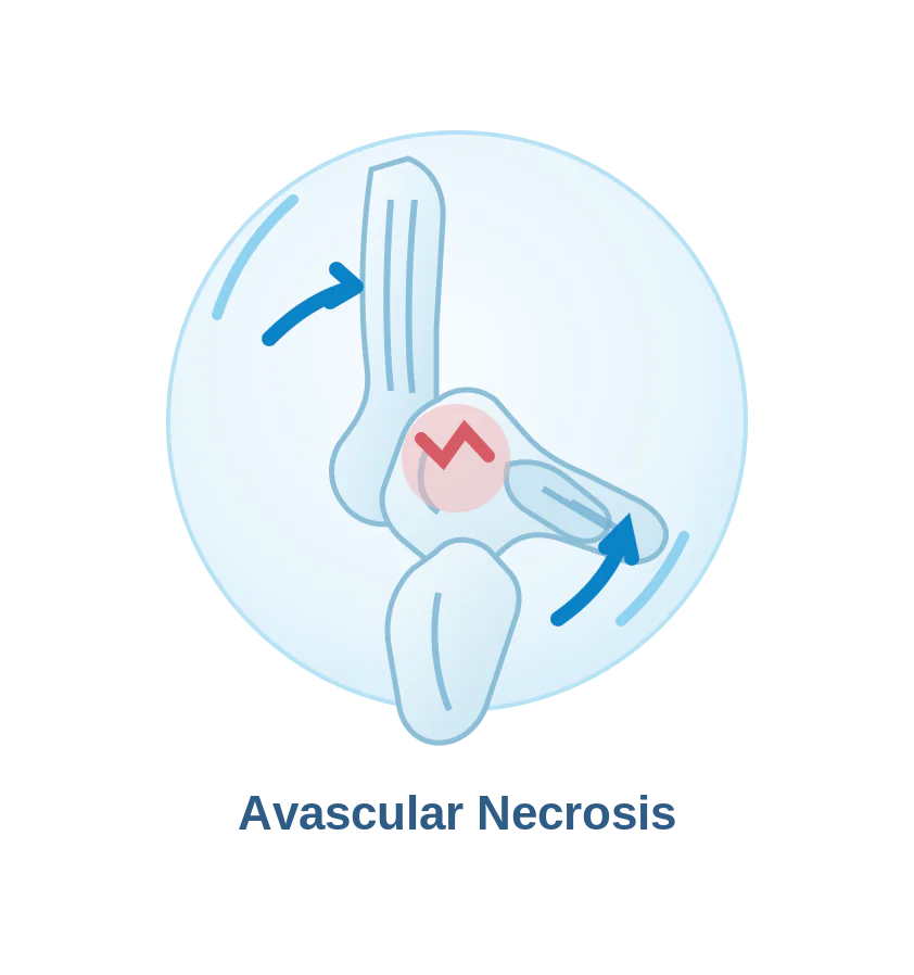 Avascular necrosis affecting ankle bone health