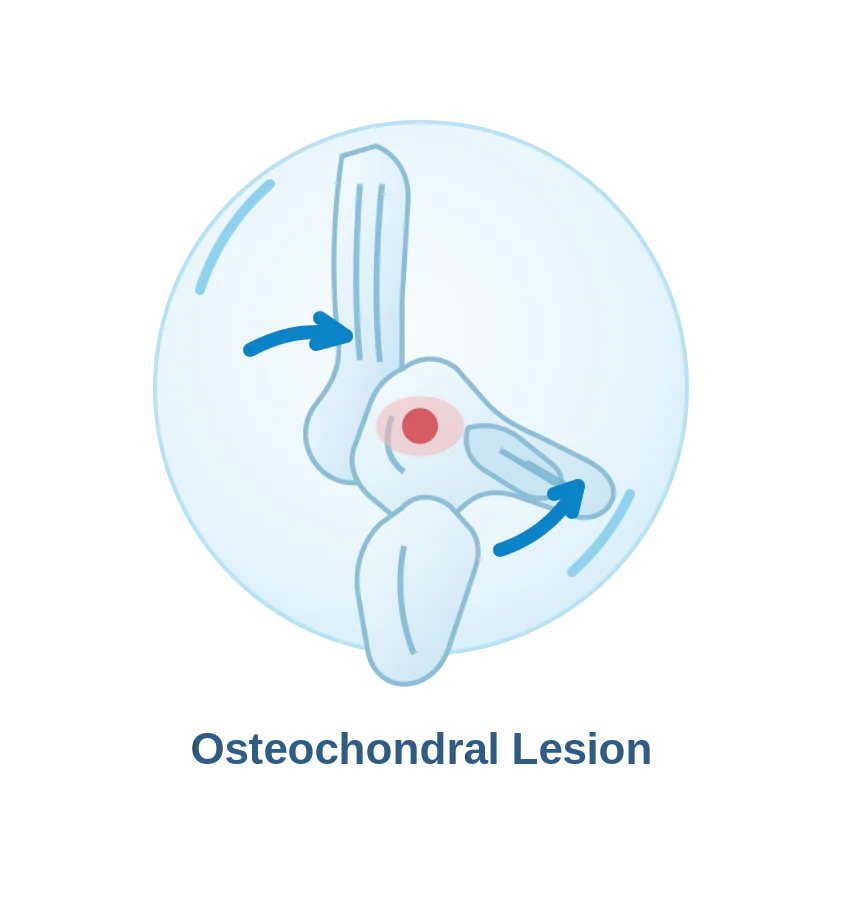 Osteochondral lesion affecting ankle cartilage and bone
