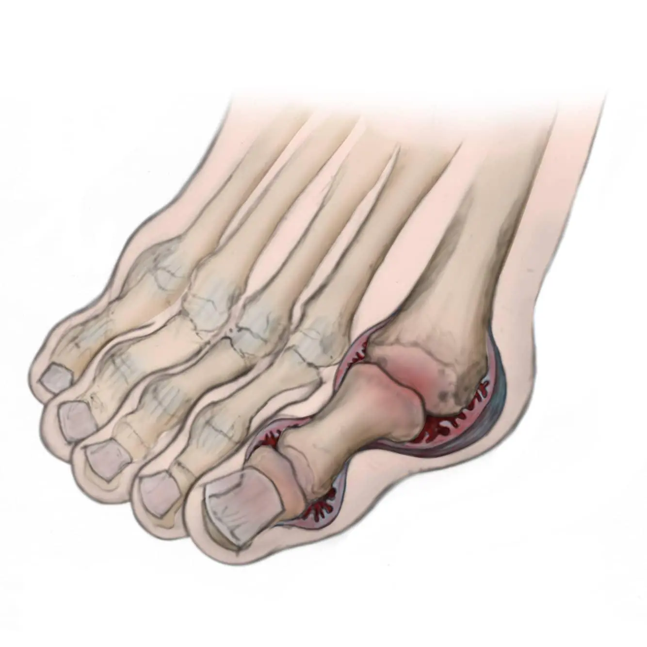 Rheumatoid arthritis affecting forefoot joints and toes