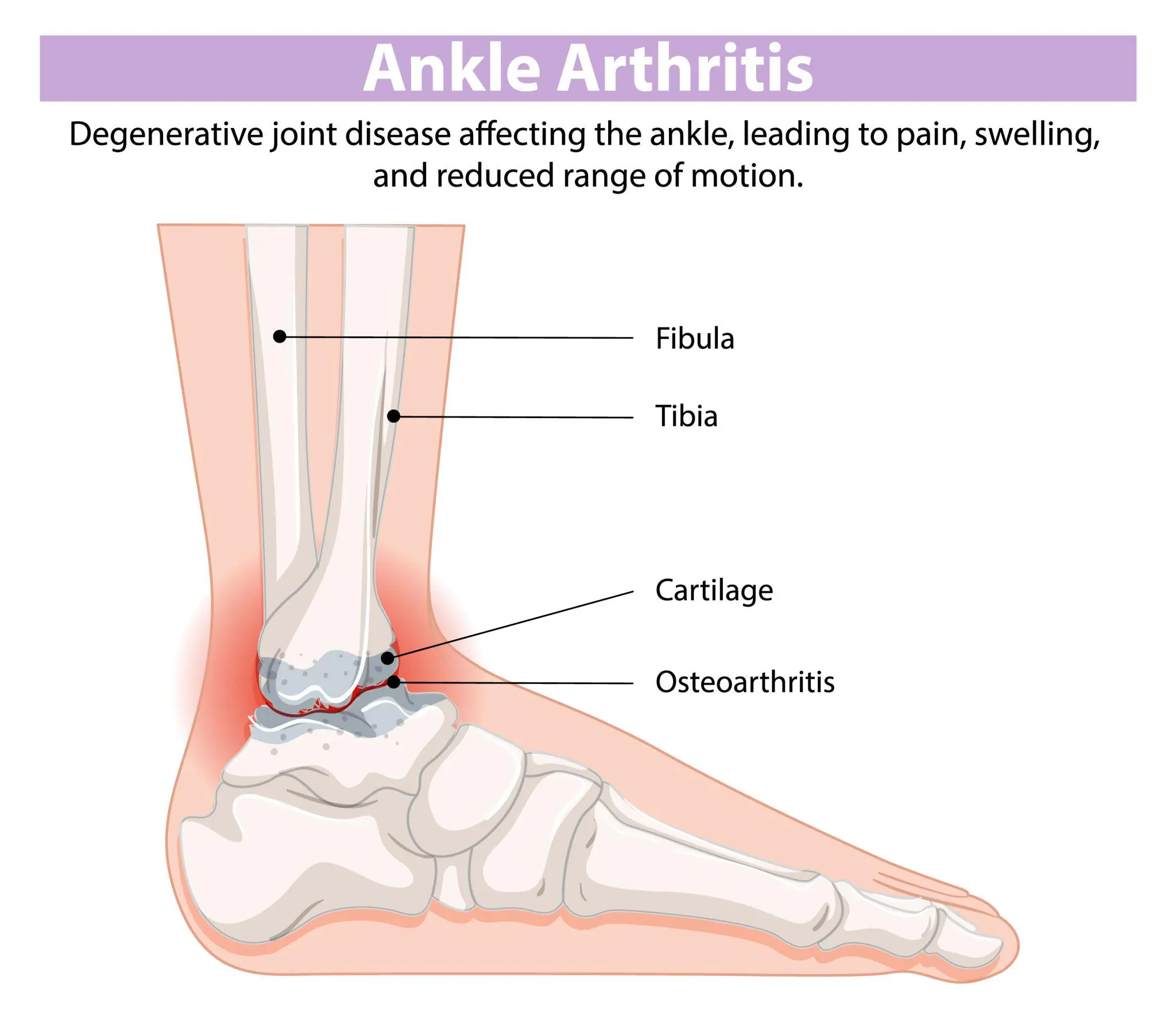 Ankle osteoarthritis affecting joint movement